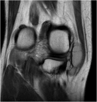 Meniscal Cyst 2